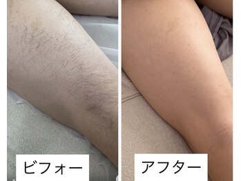 ヴィクトリアサロン(VICTORIA SALON)/大人気脱毛