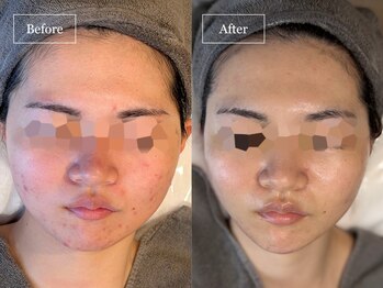 キュレイテッドスキン(CURATED SKIN)/ニキビ/跡/毛穴/しわ