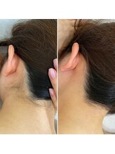 インベスト(INVEST)/うなじ脱毛