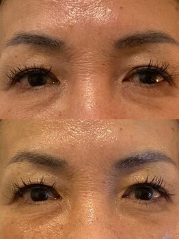 ビーアイリー(Be irie)/フェイシャルエステ直後の変化