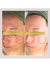 サンテボーテ(Sante Beaute)/【ヒト幹細胞フェイシャル5回】