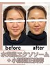 【院長担当】水光肌エクソソーム＋小顔矯正美容（肌質・顔の大きさ）