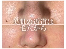 毛穴汚れをすっきり除去し、透明感あふれる肌へ。