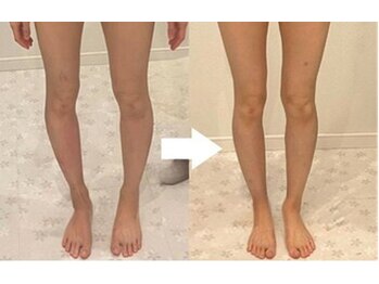 ビーエムビー(BMB)/O脚