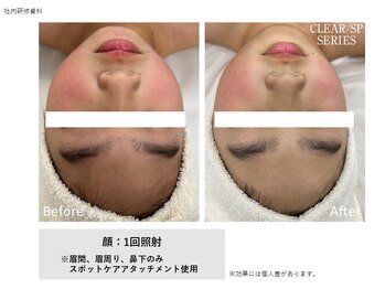 ユーセレクト ビューティー プラス(U-SELECT BEAUTY PLUS)/お子様のお顔の産毛も脱毛可能!