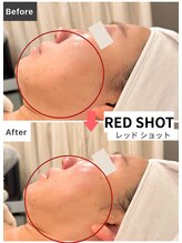 エトワール(etoile)/レモンボトル超えのRED SHOT!!