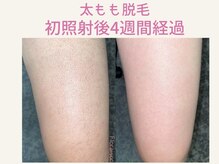 フロレゾン(Floraison)/太もも脱毛 経過