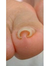 フェイシャル専門サロン サロン ド ウイッシュ/丸亀痛い爪でお悩みの巻爪50代