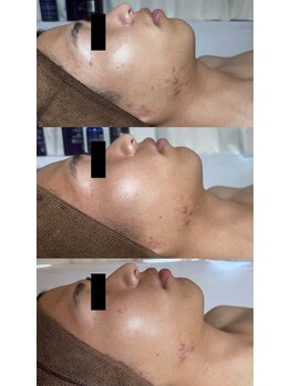 ネオオアシス トウキョウ(ネオOASIS TOKYO)/ハーブピーリング（剥離あり）