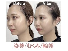 ラプリ 銀座店(Raplit)/隆鼻＋輪郭矯正40分10回