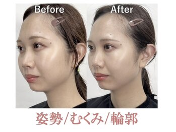 ラプリ 銀座店(Raplit)/隆鼻＋輪郭矯正40分10回