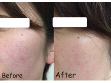 マインドール/毛穴パックで毛穴の大掃除