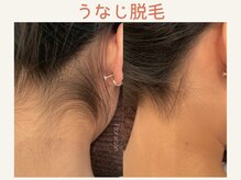 フロレゾン(Floraison)/うなじ脱毛 10回照射後