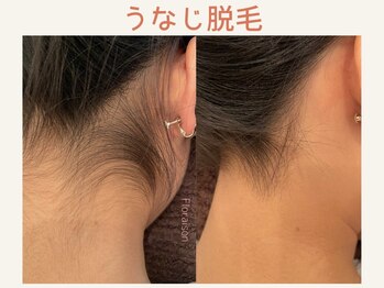 フロレゾン(Floraison)/うなじ脱毛 10回照射後
