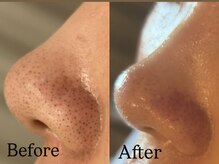 ビューティービレッジ(Beauty village)/毛穴にお悩みの方！根本から改善