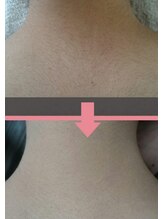 エミエット(Emiette)/うなじケア／ビフォ-アフタ-