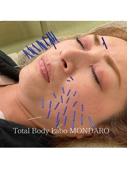 モンダロ(MONDARO)/美容鍼