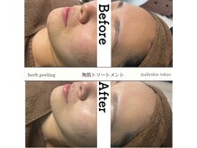 アリー(ALLY)/陶肌トリートメント