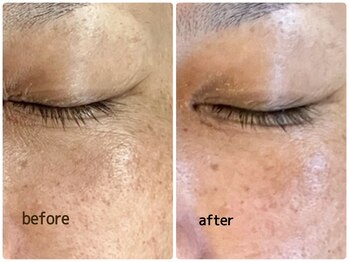 エステティックジュビラン アンビエンテ 福井南店/目元のシワケア