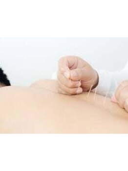 鍼灸施術を受けたい