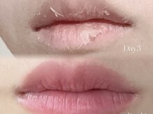 ハーモニー(harmony)/ローマピンク　口ビル