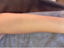 ヨハク(YOHAKU)/20代前半　男性　6回施術　after