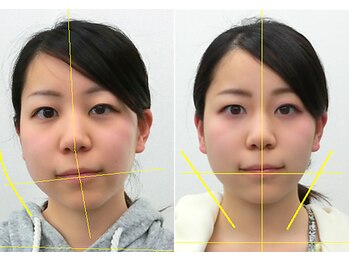 宮崎整体院/【小顔矯正・顔の歪み矯正】