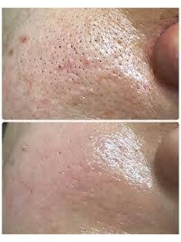 セラ(SERA)/サーマトリックス