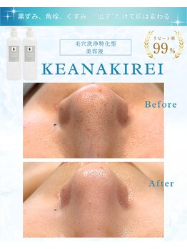 リアム(LiAm)/毛穴洗浄