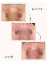 レトラ鍼灸院/毛穴洗浄