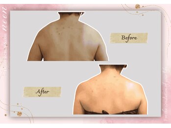 ヌーン(noon)/首・肩のつらさを改善したい