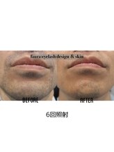 ファウラ(faura:)/メンズ　ひげ脱毛
