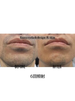 ファウラ(faura:)/メンズ ひげ脱毛