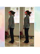 カイロプラクティック コダマ(KODAMA)/姿勢矯正ビフォーアフター