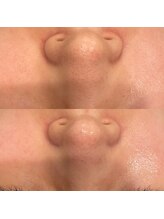 アンドラスター(andlaster)/やればハマる毛穴洗浄！！★