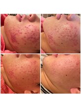 シェリモ(CHERIMO)/VOSサロンケア　ブラック 3回