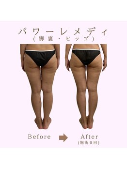 ルア(LuA.)/脚スッキリ◎パワーレメディ！