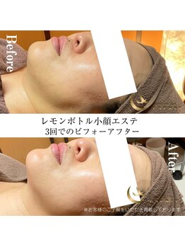 エスプリ 新宿店/小顔調整新宿・レモンボトル