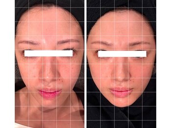 ナル(naru.)/臍帯ダブルで肌巻き戻し