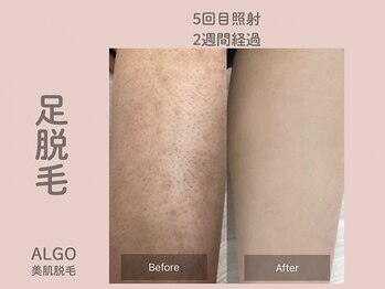 アルゴ 山口宇部店(ALGO)/脱毛初めて5回でこの仕上がり!