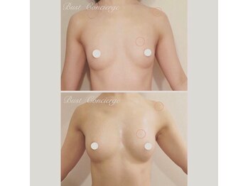 ソラ(sora)/バストアップ・バストケア症例★