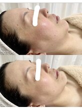 メナード 中津北店/新ブライトニングパックで対策☆