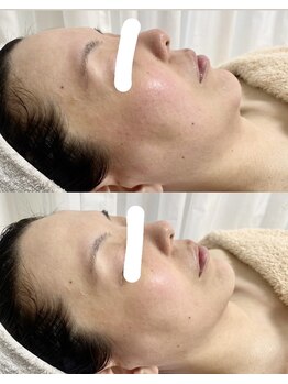 メナード 中津北店/新ブライトニングパックで対策☆