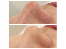 エステティック トリートメント クオリティ(Esthetic Treatments Quality)の雰囲気（しつこい毛穴の黒ずみ、角栓に毛穴ゴッソリ改善コース）