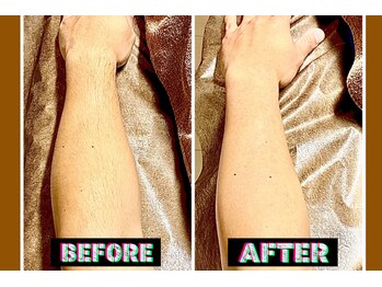 メンズスリーナインサロン(Men's ThreeNines Salon)/腕脱毛