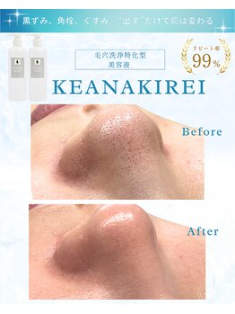 リアム(LiAm)/毛穴洗浄