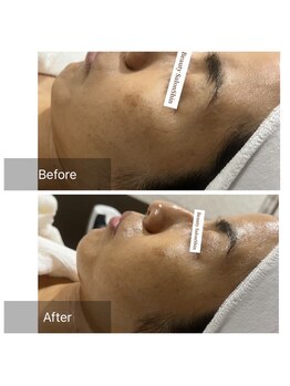 シン(Shin)/新世代ラクトピール