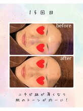 リリアン(lirien)/毛穴/毛穴ケア/毛穴洗浄/駒込