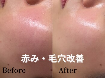 ユンプラス(yun+)/【赤み・毛穴改善】ラミピール