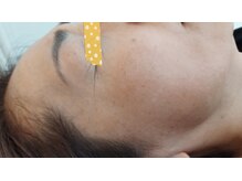 麻謝/純正レチノール２　Before